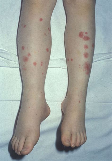 Purpuric And Petechial Rashes In Adults And Children Initial