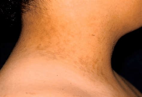 Is Acanthosis Nigricans A Reliable Indicator For Risk Of Type 2