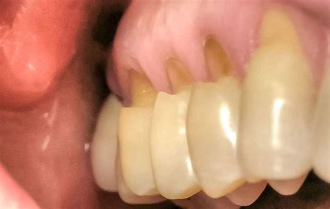 Abfraction Lesion What It Is Causes And Treatments Longevita Dental