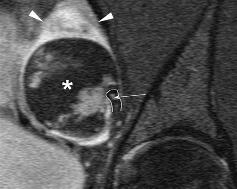 Ovarian Dermoid Cyst With Teeth Bmj Case Reports