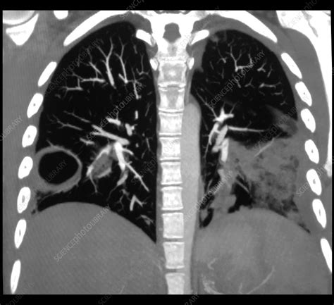 Pneumonia And Lung Abscess Ct Stock Image C0394179 Science