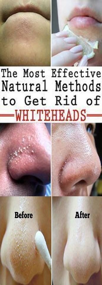 How To Get Rid Of Whiteheads Naturally How To Get Rid Of Pimples