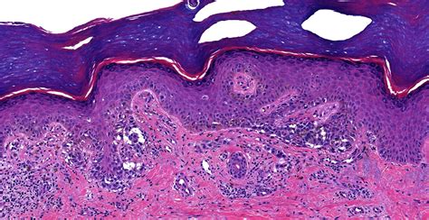Pathology Outlines Invasive Melanoma
