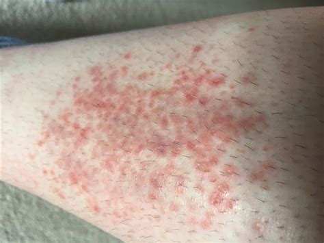 Luthfiannisahay Butterfly Rash And Itchy Skin