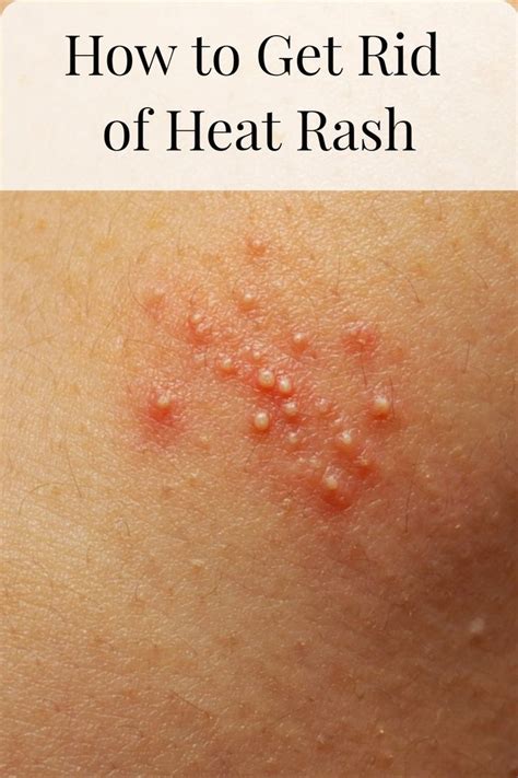 How To Get Rid Of Prickly Heat Heat Rash