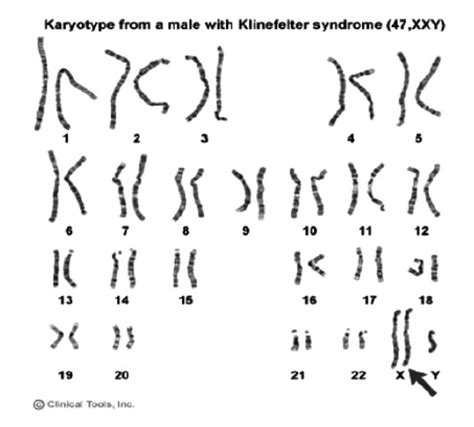 Nondisjunction Karyotype