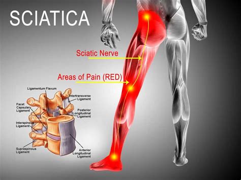 Is Your Sciatica Bothering You We Know How To Solve It Ad Sacrum