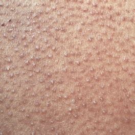 Keratosis pilaris happens when keratin, a protein found in the skin, builds up and plugs hair follicles. Simple Keratosis Pilaris Treatment Natural Remedies