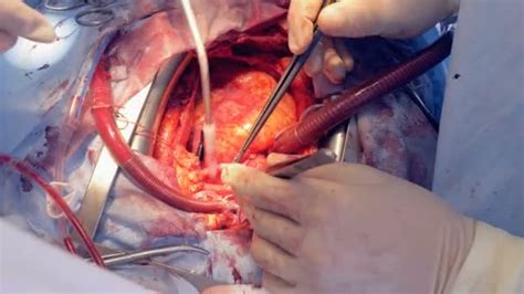 Real Heart Beats Through Open Chest During Surgery 4k ⬇ Video By
