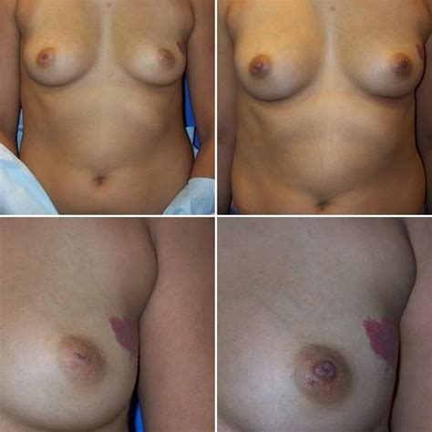 Inverted Nipple Repair Dr G Cosmetic Surgery