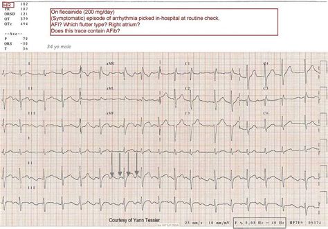 Ecg Teaching Series Atrial Flutter Ecg Guru Instructor Resources