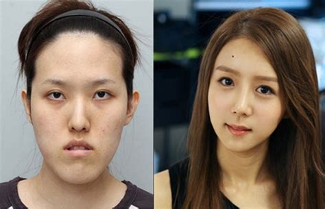 What are today's most popular plastic surgery procedures? Before and After Photos of Korean Plastic Surgery. Part 2 ...