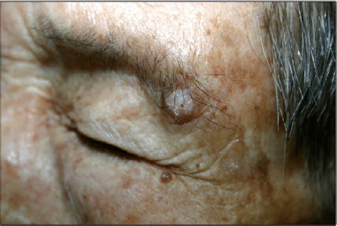 An Erythematous Hyperkeratotic Papule On The Left Eyebrow Download