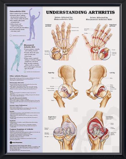 Understanding Arthritis Chart 20x26 Natural Remedies For Arthritis