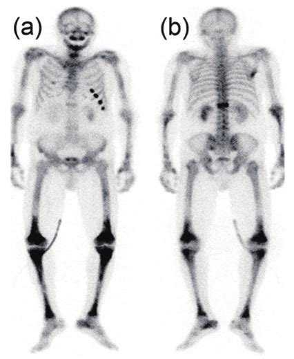 Technetium 99 99m Tc Bone Scintigraphy A Anterior B Posterior