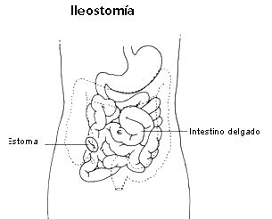 Qué es una Ileostomía Colostomía