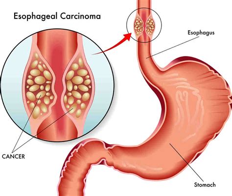 If symptoms are observed, seek medical attention immediately. Esophageal cancer | Health Ledger