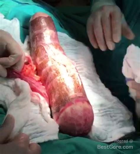 Man Needs Emergency Surgery To Remove Large Yuca Root From