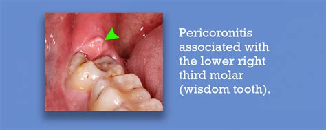 Pericoronitis Causes Symptoms And Treatments Carifree