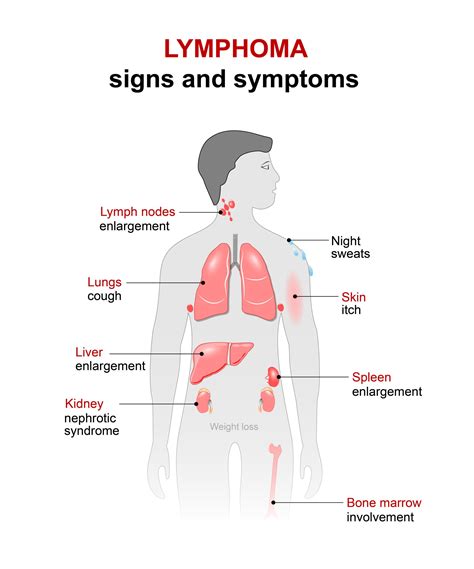 Getting Long Term Disability Ltd Benefits For Lymphoma Cck Law