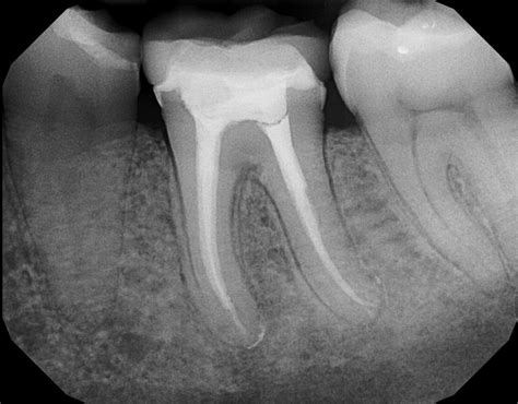 Root Canal Treatment Endodontic Therapy Ideal Dental Care