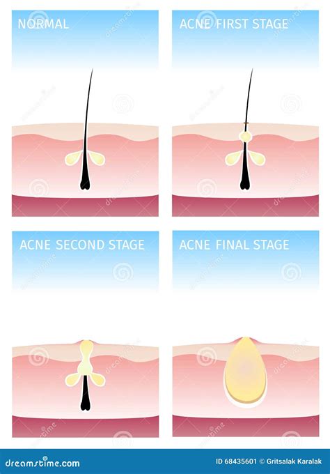 How Acne Happens Acne Stages Stock Vector Illustration Of Care