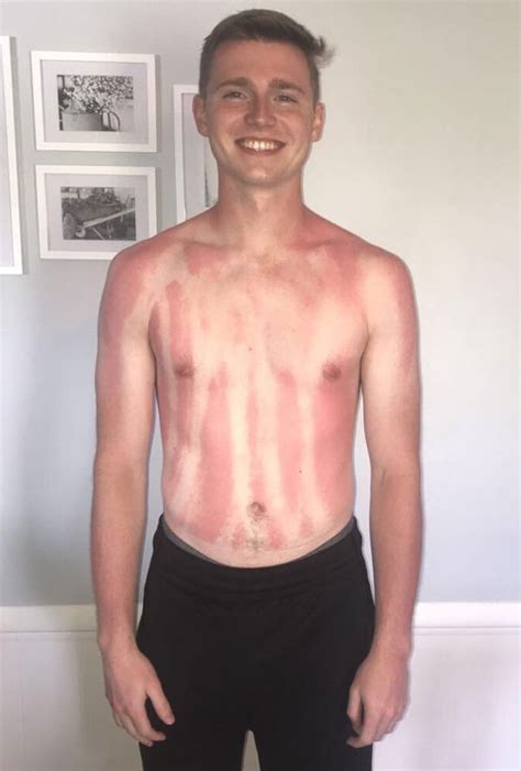 Unusual And Painful Sunburns Others
