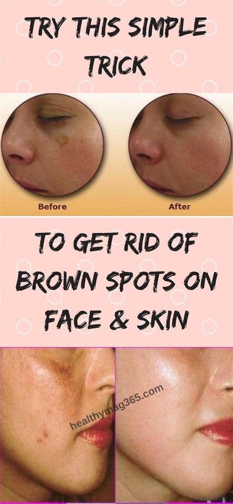 Pin By Healthy Mag 365 On Health Spots On Face Brown Spots On Face