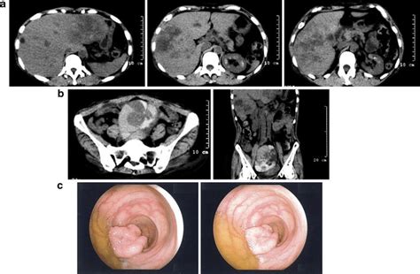 Ct Images And Colonoscopy Findings At Onset A Axial Images Of The