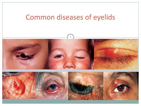 Solution Diseases Of Eyelids 1 Studypool