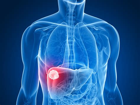 Liver Lesions Types Causes Diagnosis And More