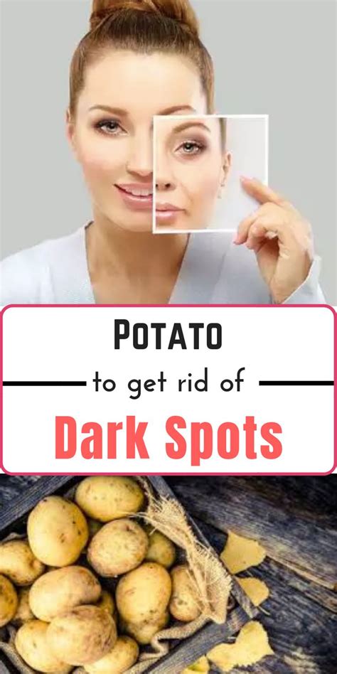 Potato A Natural Way To Get Rid Of Dark Spots Dark Spots Diy Skin