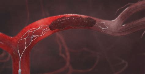 Clot Removal Device Paired With Drug Shows Benefits For Stroke Patients