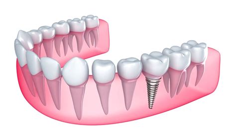 The Dental Implant Procedure How Long Does It Take