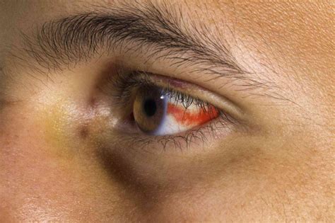 Subconjunctival Hemorrhage Odd Bloody Stains In The Eyes The Dailymoss