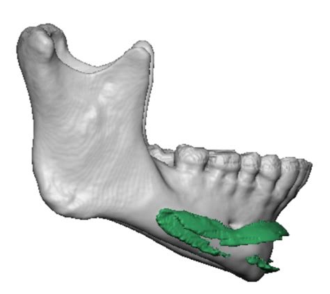3d Assessment Of Chin Implant Imprinting And Bone Overgrowth Explore