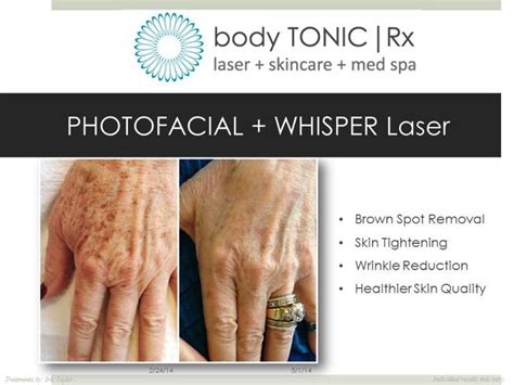 Photofacial For Hands Photofacial Brown Spots Removal Wrinkle Reduction