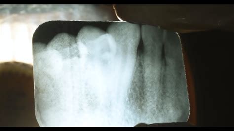 Dental X Rays Procedure And How To Film Processing Youtube