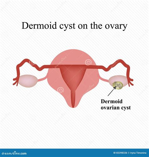 Dermoid Cyst On The Ovary Infographics Vector Illustration Stock