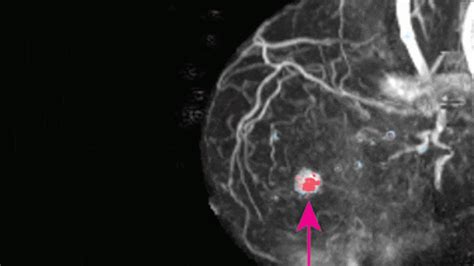 New Artificial Intelligence Tool Improves Breast Cancer Detection On