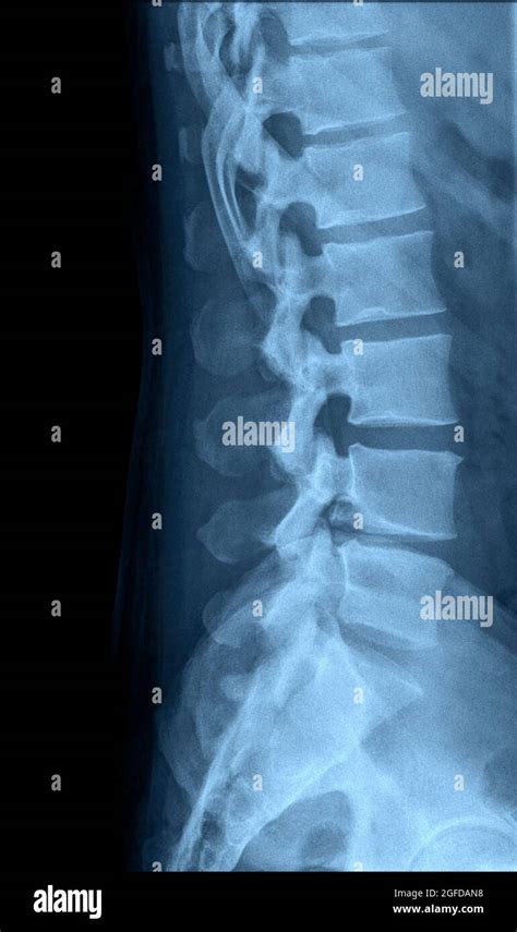 Anatomy Of Lumbar Spine Hi Res Stock Photography And Images Alamy