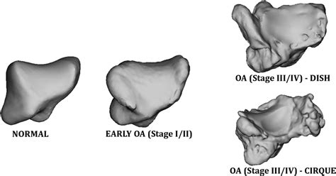 Illustration Of Arthritic Progressions In The Trapezium With 3d Bone