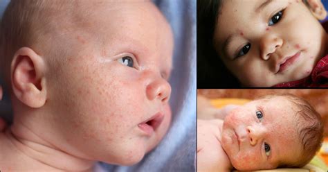 5 Causes Of Acne In Toddlers And How To Treat It