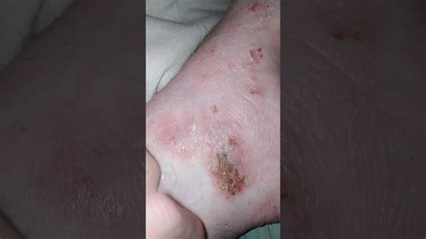 Eczema Scab Peel An Scratching Youtube