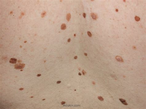 Atypical Moles Guide Definitions Pictures And Risks