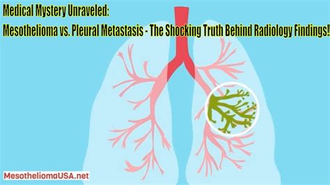 Mesothelioma Vs Pleural Metastasis Radiology Malignant Pleural