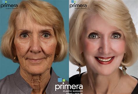 Chemical Peel Before And After Photos Patient 81 Orlando Florida