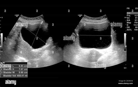 Polycystic Kidneys Ultrasound Scan Of The Kidneys Of A 42 Year Old