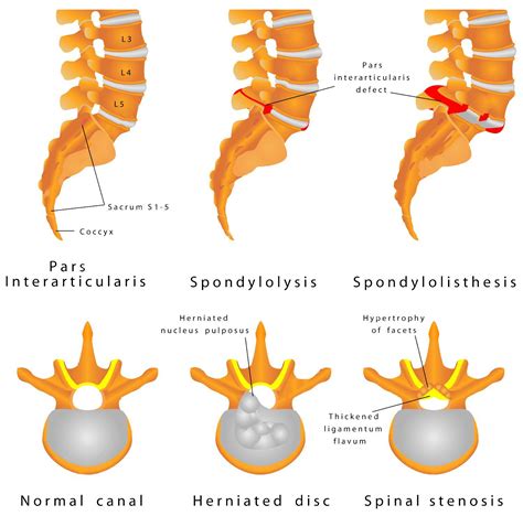 Spine Fracture Spondylolysis Spondylolisthesis Is A Defect In The Bony