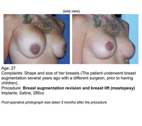 Mastopexy Breast Lift And Augmentation UF Health Plastic Surgery